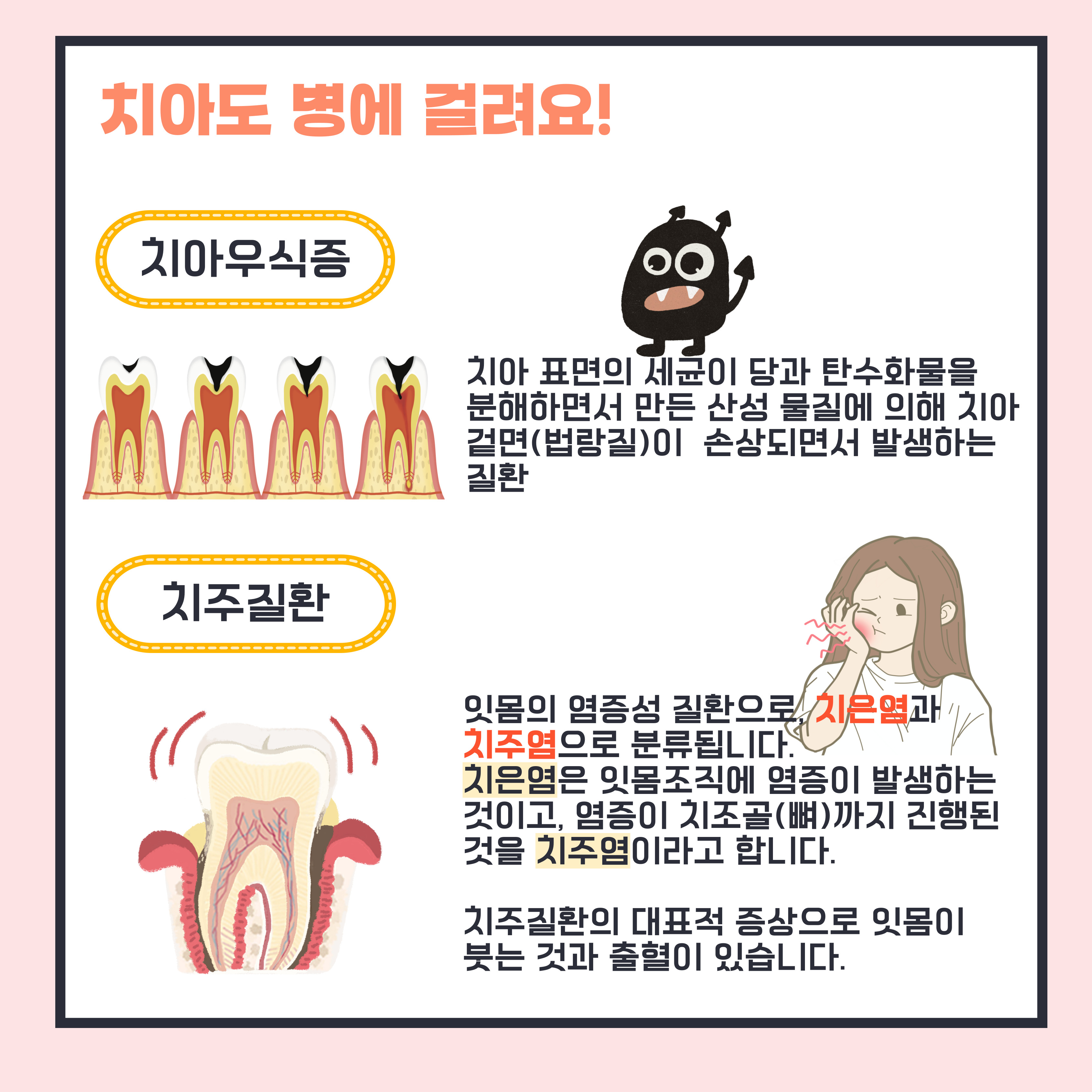 치아우식증이란, 세균이 당과 탄수화물을 분해하면서 만든 산성물질에 의해 치아 겉면이 손상되는 것이고 치주질환은 치은염과 치주염으로 분류되는 잇몸성 염증질환임.